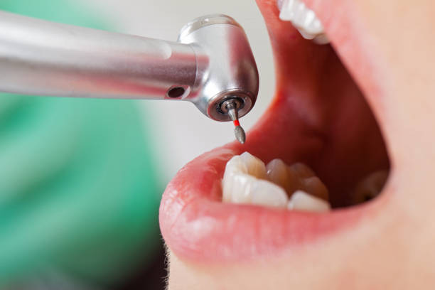 Best Dentist for Tooth Abscess  in Buhler, KS
